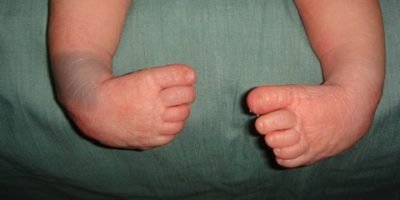 Pie plano valgo flexible sintomático